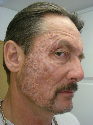 Scar From Burn